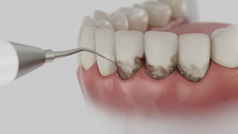 Reliable Teeth Whitening contractor in Poway, CA by Smile Center Dentistry